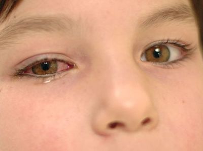 hogyan lehet ellenőrizni látását kötőhártya-gyulladással szemcsepp idősek számára